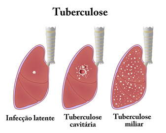 A tuberculose continua sendo motivo de preocupações até os dias de hoje, apesar de acompanhar a humanidade há muitos séculos.
