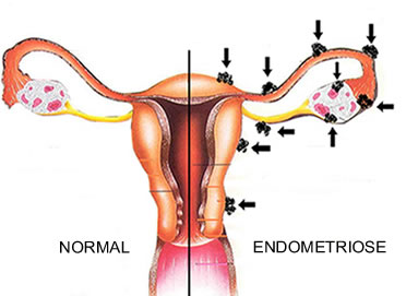 As setas da figura nos mostram os locais mais comuns para o aparecimento da endometriose.