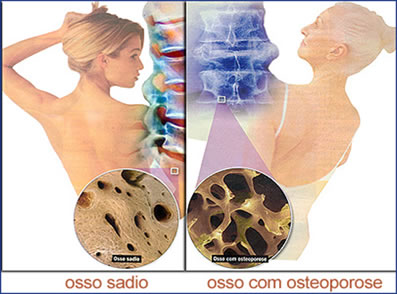 Na figura podemos observar um osso sadio, de uma pessoa jovem, à esquerda; e um osso com osteoporose, de uma pessoa de idade mais avançada, à direita