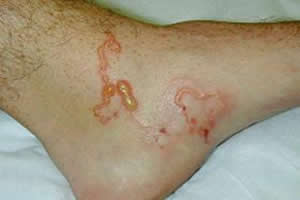 Lesões causadas pela larva migrans.